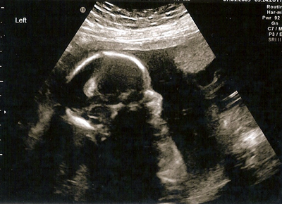 Twenty week scan of our new baby